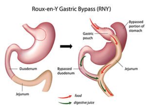 obesity treatment